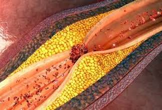 Otyłość i&nbsp;miażdżyca – zakaźna teoria